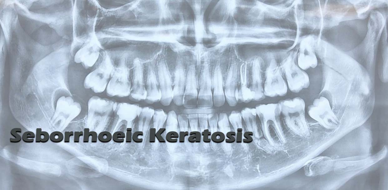 Seborrhoeic Keratosis